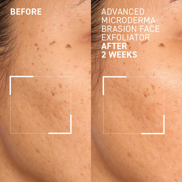 Advanced Microdermabrasion Face Exfoliator (Billede 3 af 4)