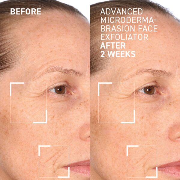 Advanced Microdermabrasion Face Exfoliator (Billede 4 af 4)